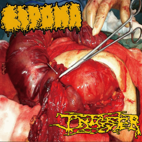 Lipoma : Lipoma - Infester